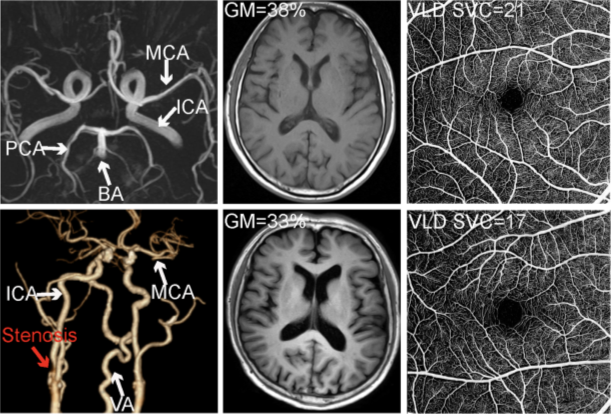 Researchers posit that retinal and choroidal microvascular measures “offer substantial incremental value for individual risk stratification in vascular contributions to cognitive impairment and dementia.” These photos from the study show representative multimodal imaging of a control participant (top) and a nondiabetic patient with noninfarcted large artery stenosis (bottom). CT angiography demonstrates severe carotid artery stenosis in the patient with LAS (red arrow). 